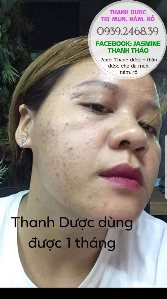 Serum đông y trị mụn Thanh Dược