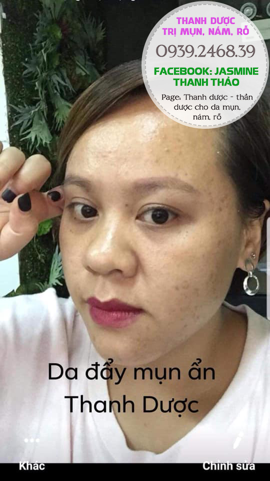 Serum đông y trị mụn Thanh Dược