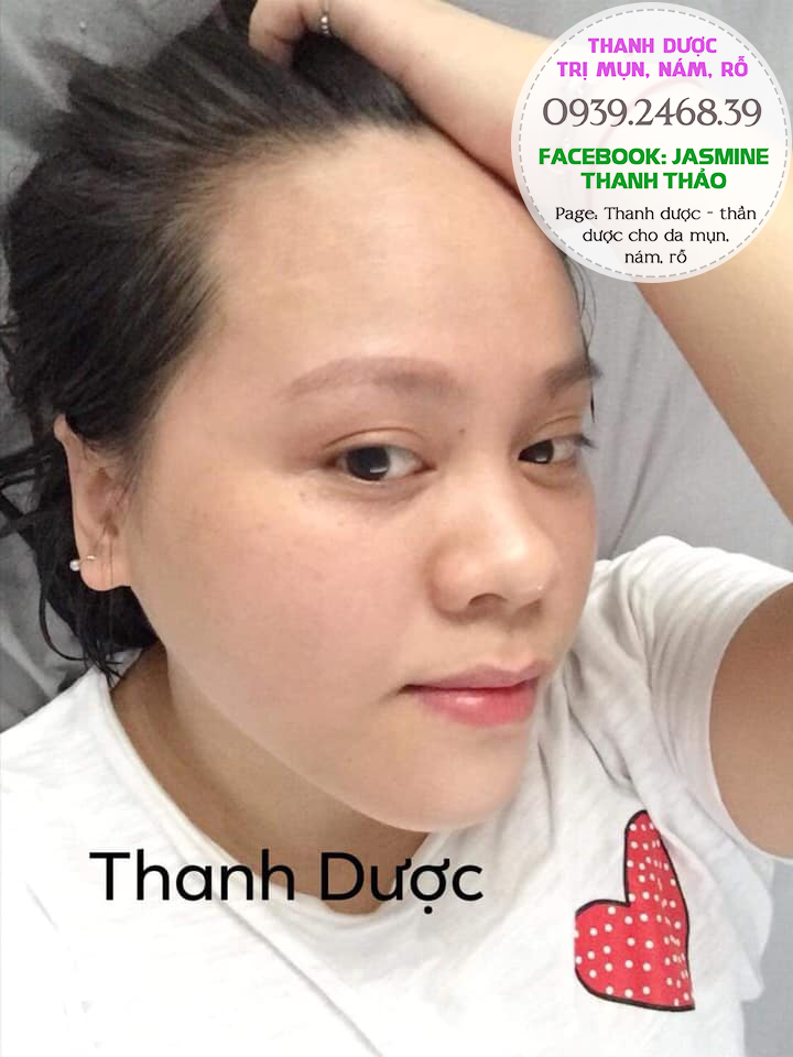 Serum đông y trị mụn Thanh Dược
