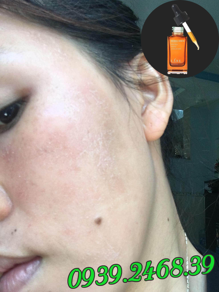 Trị mụn tại nhà với Serum Thanh Dược Lare