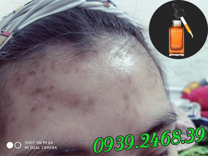 Trị mụn tại nhà với Serum Thanh Dược Lare
