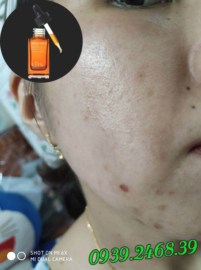 Trị mụn tại nhà với Serum Thanh Dược Lare