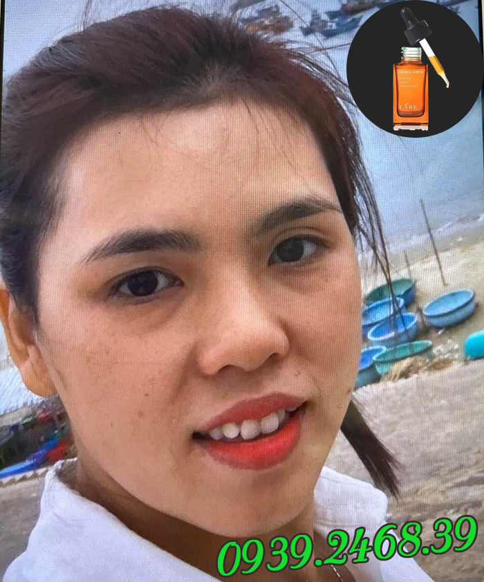 Trị mụn tại nhà với Serum Thanh Dược Lare