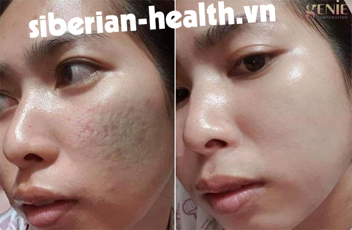 [Hàng chính hãng] Kem Trị Sẹo Rỗ Genie Fix Skin No MTS Hàn Quốc